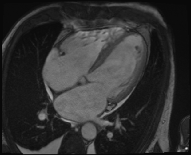 Kardiale Bildgebung Mrt Radiologie M Nchen